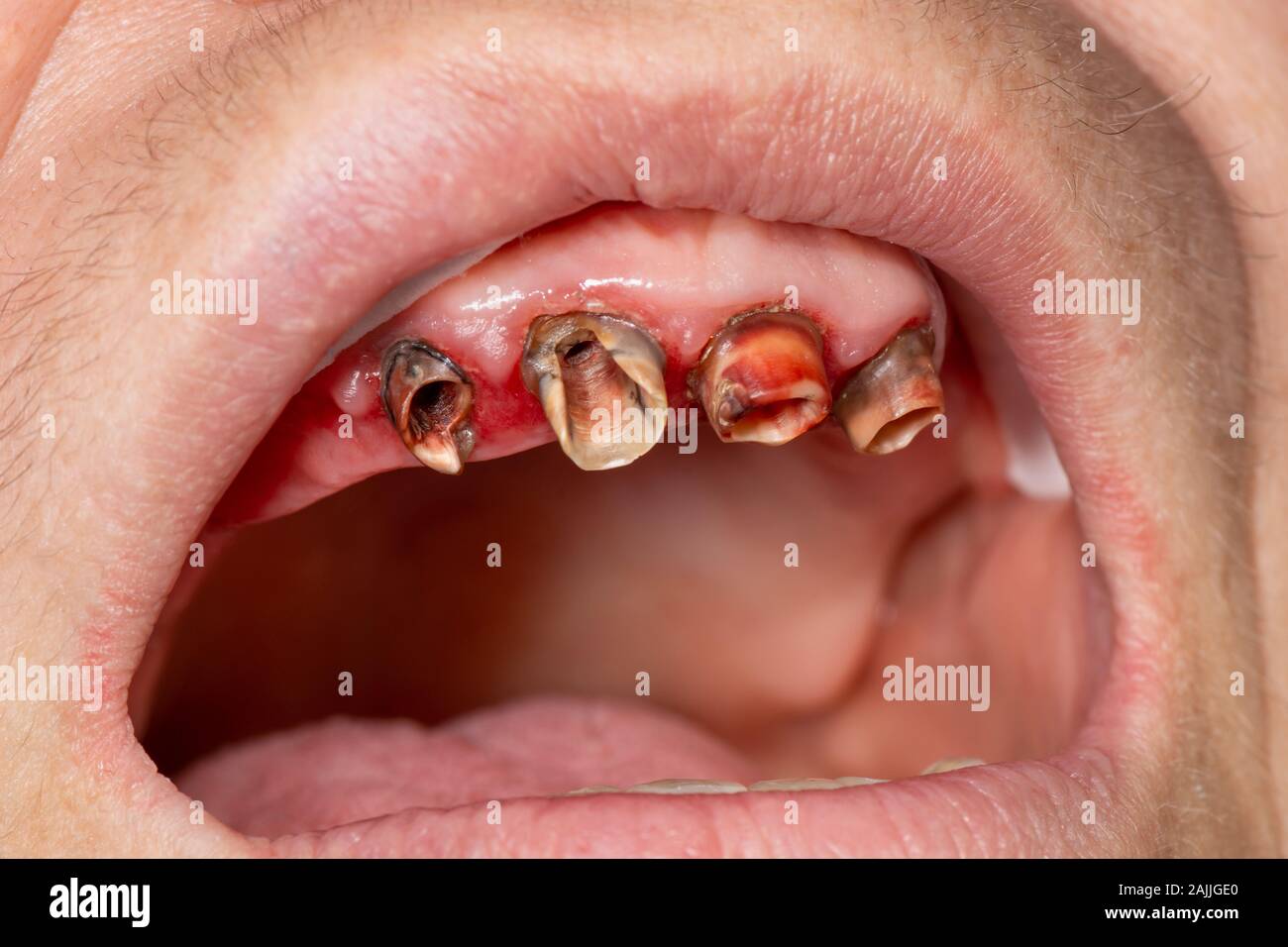 Corona Dental cerámica metal cerca de la boca del paciente en la clínica  dental. El concepto de prótesis con el uso de implantes y prótesis dentales,  a Fotografía de stock - Alamy