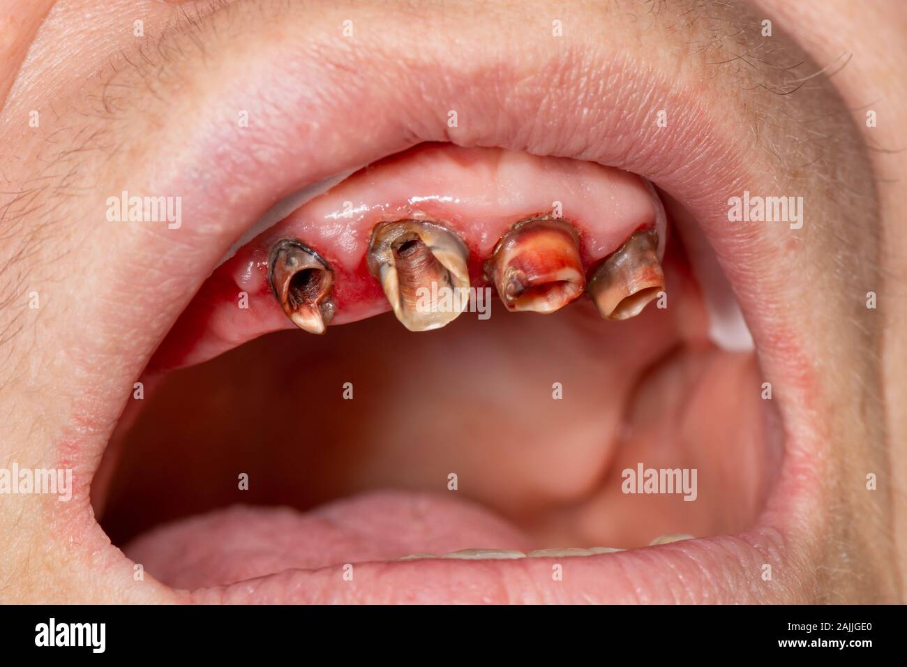Corona Dental cerámica metal cerca de la boca del paciente en la clínica dental. El concepto de Corona Dental cerámica metal cerca de la boca del paciente en la clínica dental. El concepto de