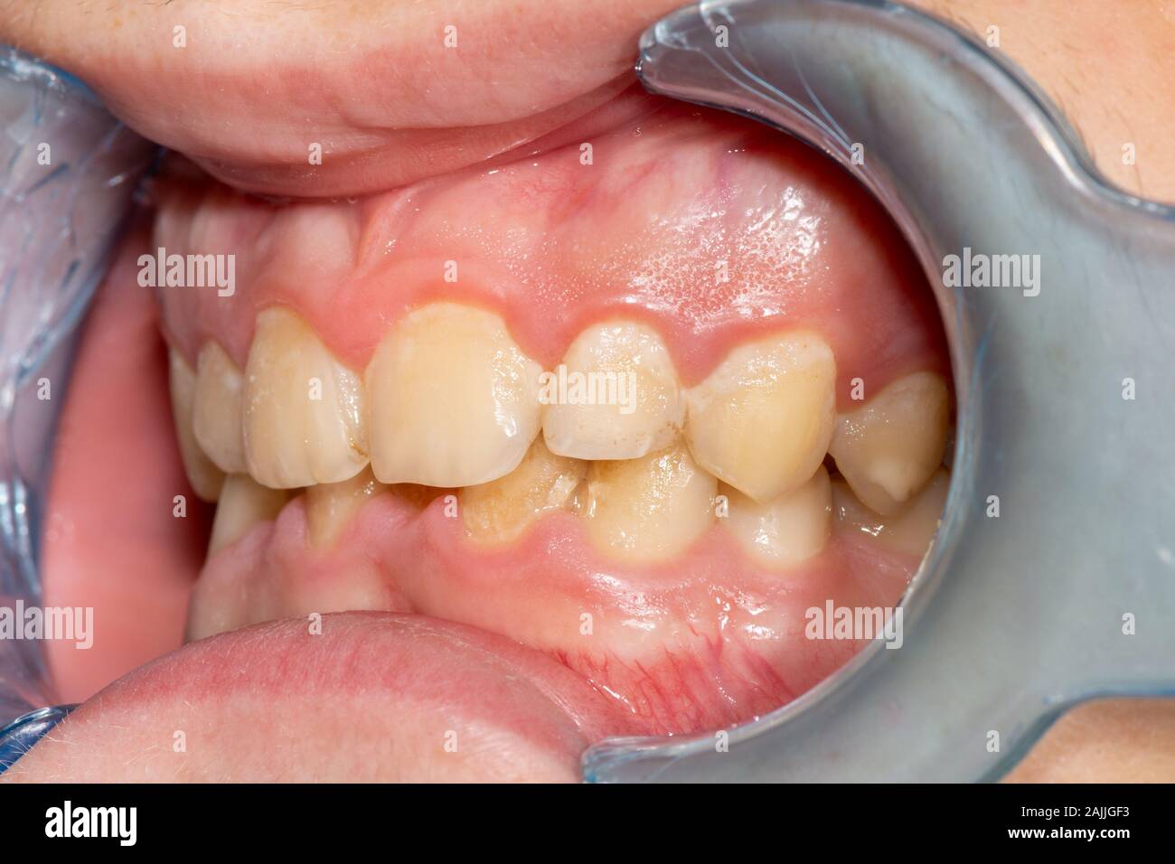 Persona con experiencia plato chocar Calculo dental fotografías e imágenes de alta resolución - Alamy