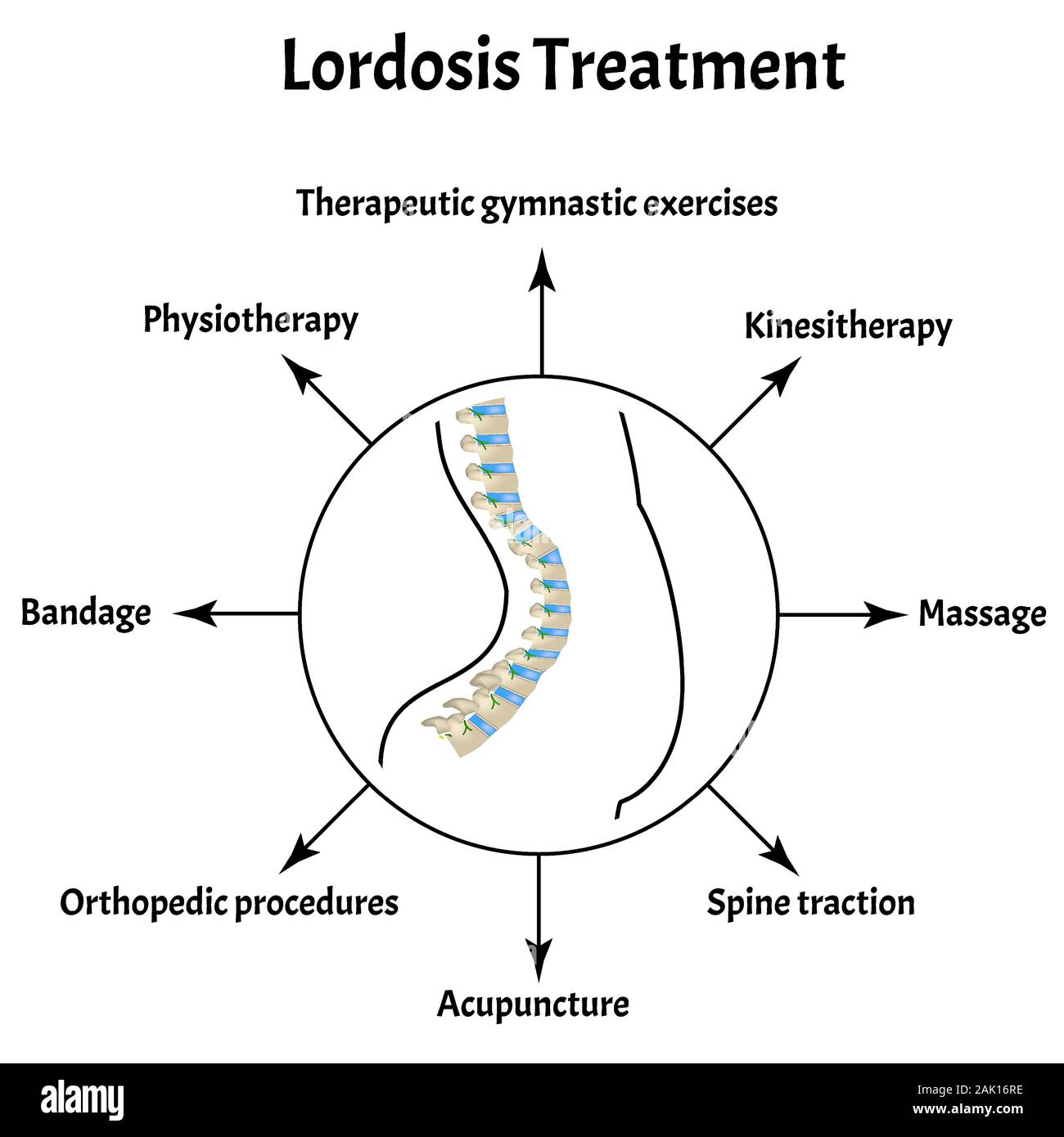 Tratamiento de la lordosis. Curvatura vertebral, cifosis, lordosis