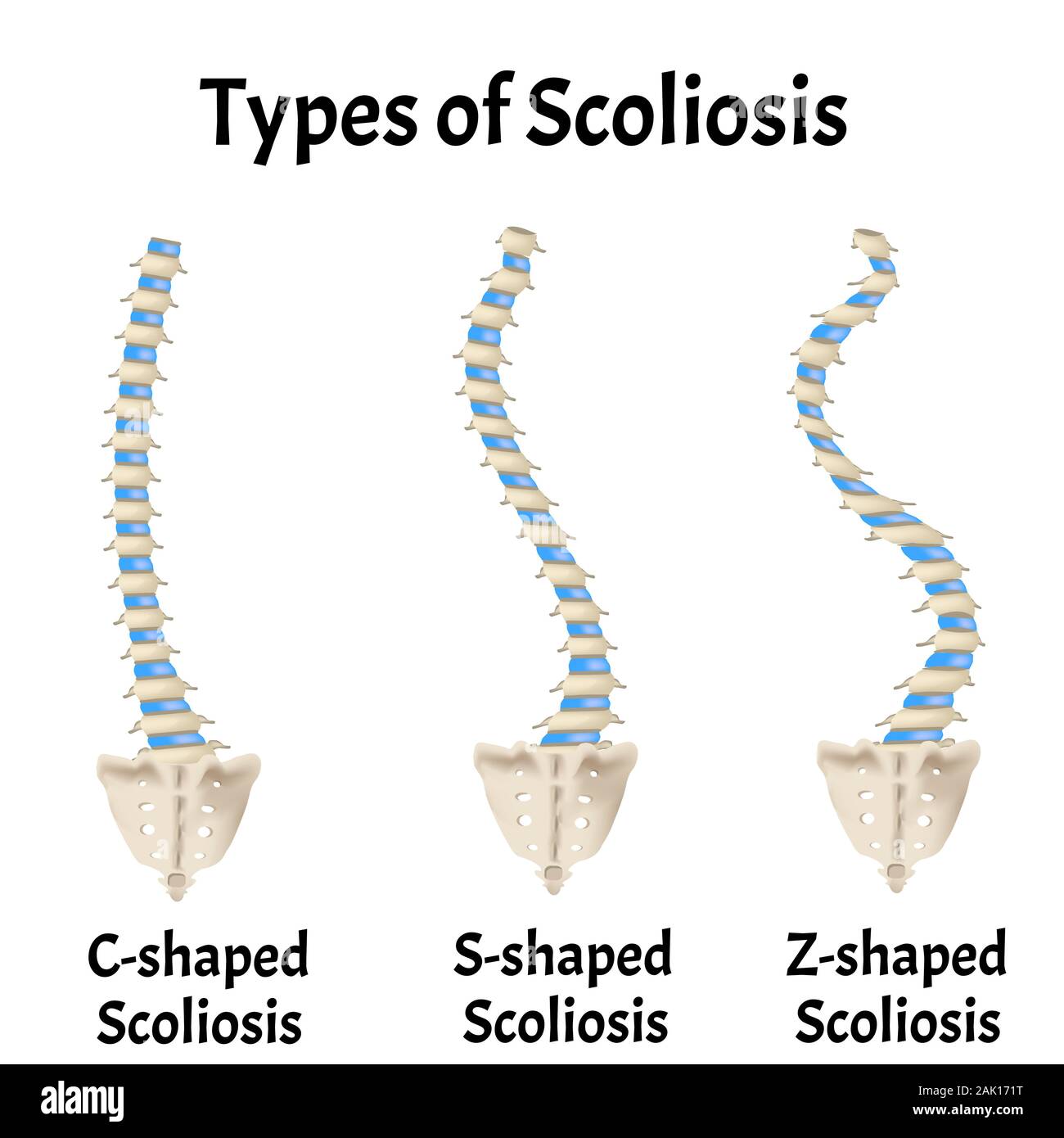 Tipos De Escoliosis C S Z Conformado La Escoliosis Dextroscoliosis Levoscoliosis Curvatura Vertebral Cifosis Lordosis Artrosis La Infografia Vector Imagen Vector De Stock Alamy