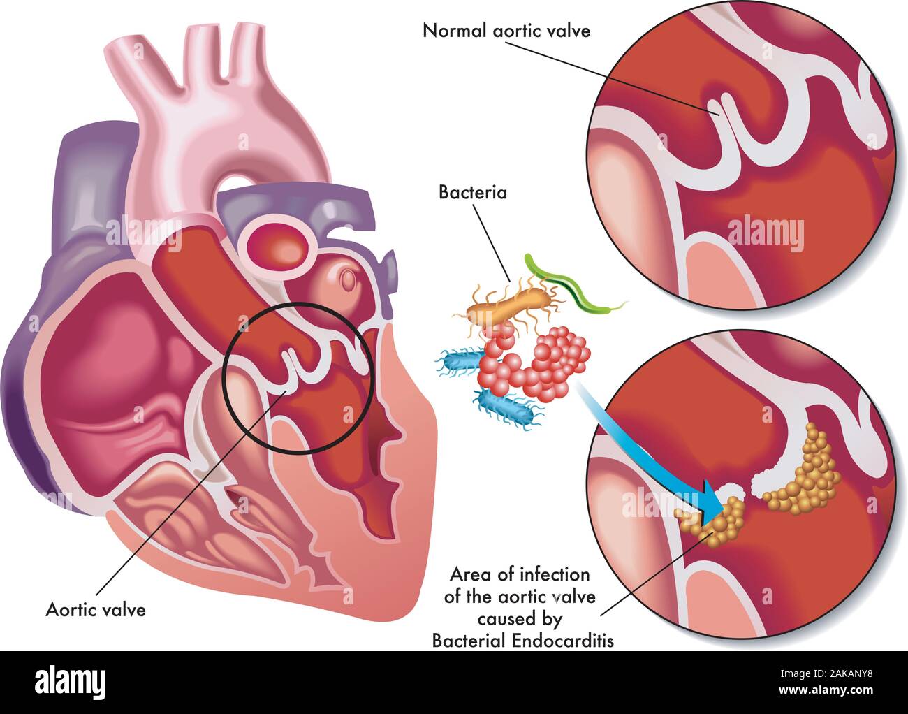 Ilustración médica de los síntomas de endocarditis bacteriana. Ilustración del Vector