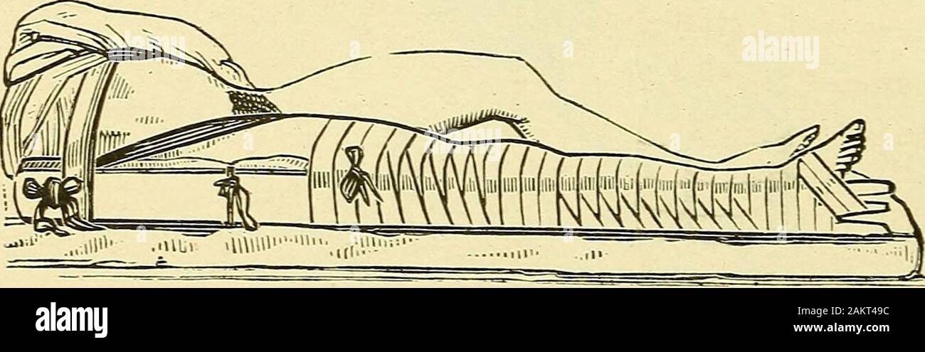 El Mariner's Medical guide : diseñado para el uso de los barcos, las familias, y plantaciones : contienen los síntomas y el tratamiento de enfermedades: también, una lista de medicamentos, sus usos, y el modo de administración, cuando un médico no puede adquirirse : seleccionados de obras médicas estándar . Fractura de la cadera. Un excelente y sencillo método de tratamiento de este aditivo formi dable de lesión es representado en el acompañamiento illustra-ción. Un trozo de cartón, una pulgada de grueso y de ancho, o fourinches.mayor si la extremidad inusitadamente stout, iscut de tal longitud como para llegar desde el corto costillas tofour pulgadas bey Foto de stock