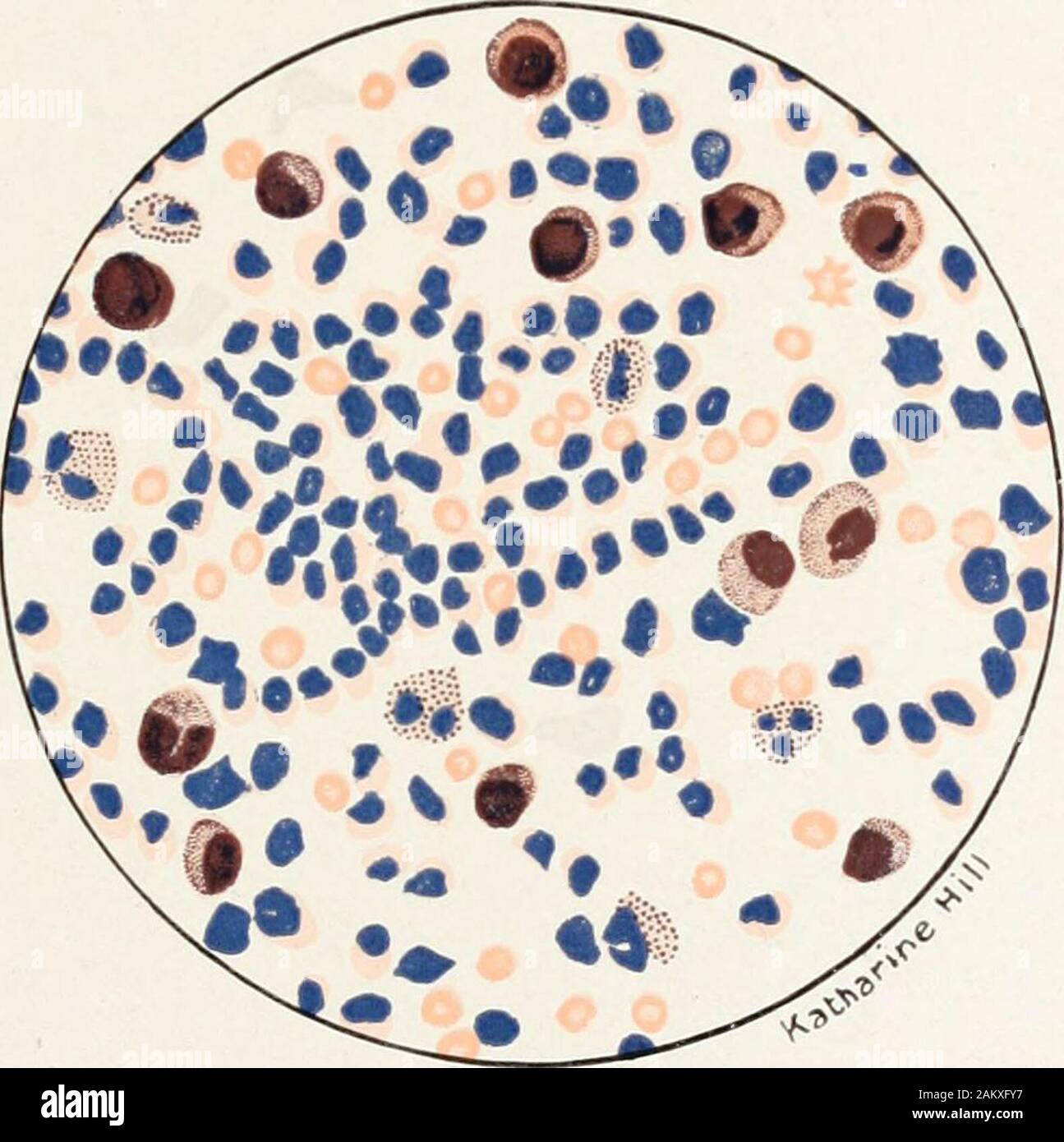 Los métodos de diagnóstico, químicas, bacteriológicas y microscópico, un  libro de texto para estudiantes y practicantes . e polinucleares  mononucleares y formas pueden obtener. Eneste tipo de pleuresía el  eosinophile las células