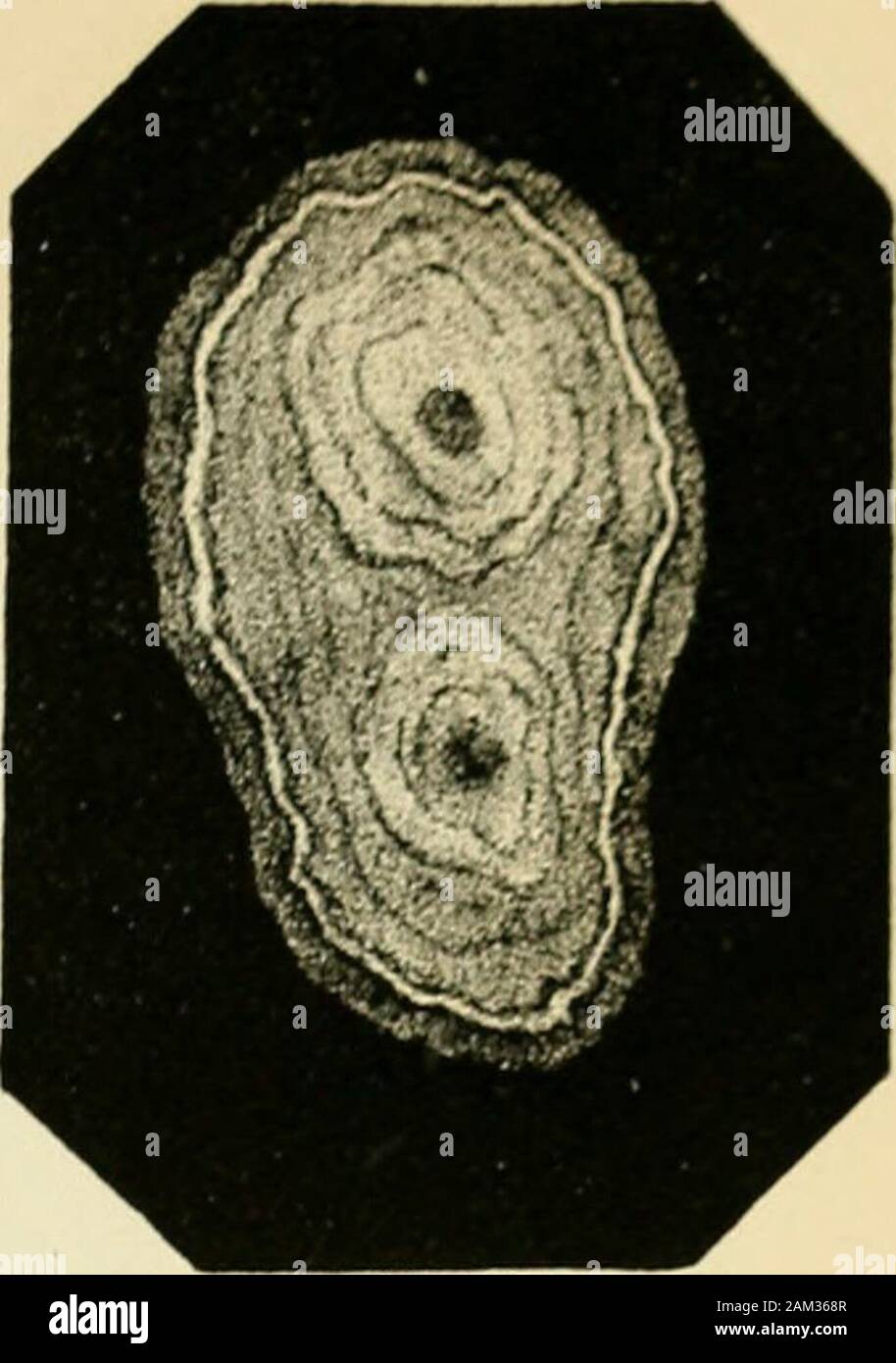 Inflamaciones de la vessie et catarrhe, gravelle, des divers moyens de combattre ces afectos . Foto de stock