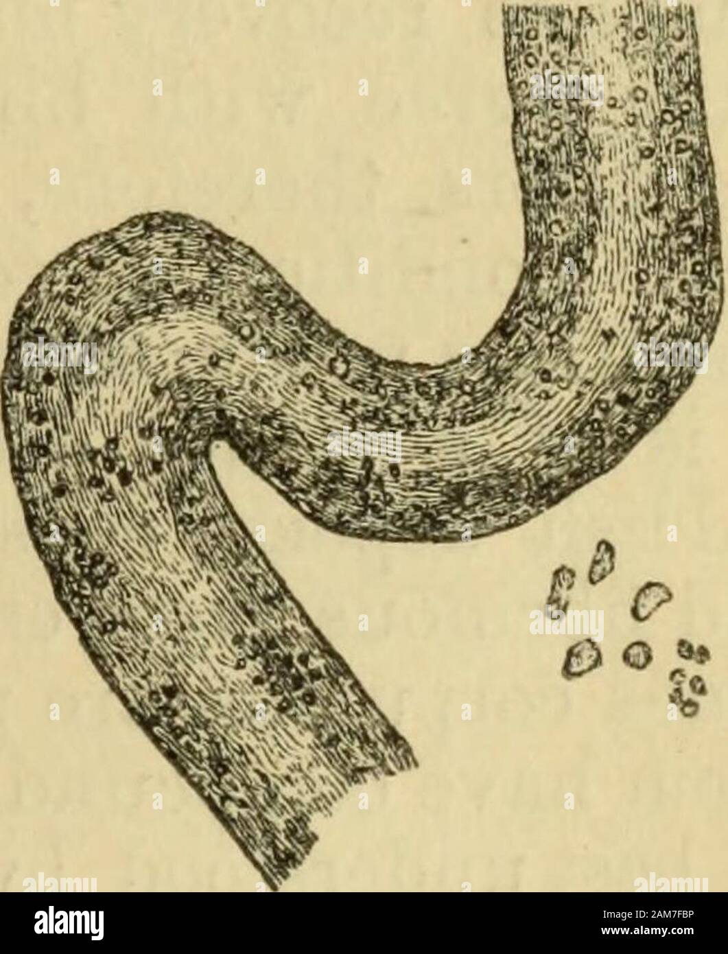 Manual de anatomía patológica . inmany casos pequeñas manchas de color rojo oscuro, que son el resultado de rhage haemor-en y entre los tubos. TheMalpighian tufts están también claramente a todas luces satisface minuto, rojizo, sub-transjDarent granos,prominente en la superficie de corte. En themedullary conos, las congestionadas vesselsform largo rojo oscuro y rayas. Un fluido sanguíneo somewhatturbid theinjected figura en los cálices y la pelvis. La cápsula,si el hypersemia ha acontecido una healthykidney, pueden desprenderse fácilmente. Micro-scopy muestra el othercapillaries Malpighian y cargado con sangre, extravasationsometimes en el ca Foto de stock