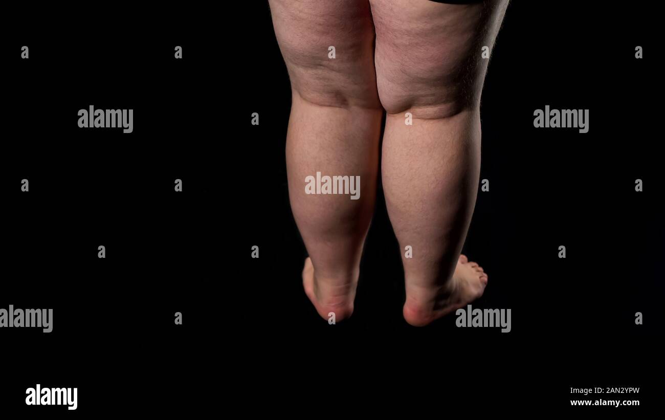 de grasa de las piernas con celulitis flacidez la piel, el exceso de ingesta de alimentos cuidado de la salud Fotografía stock - Alamy