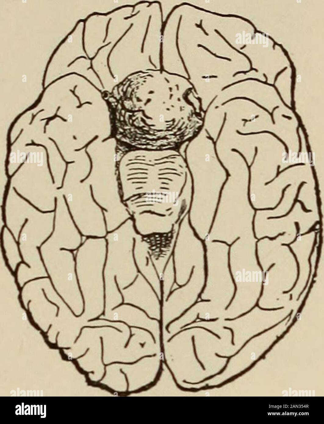 Enfermedades nerviosas y mentales . Fig. 210.—1, base de cráneo que muestra  la excavación de la silla turca y, 2, tumor pituitario en un caso de  acromegalia (Marie). La fosa pituitaria se