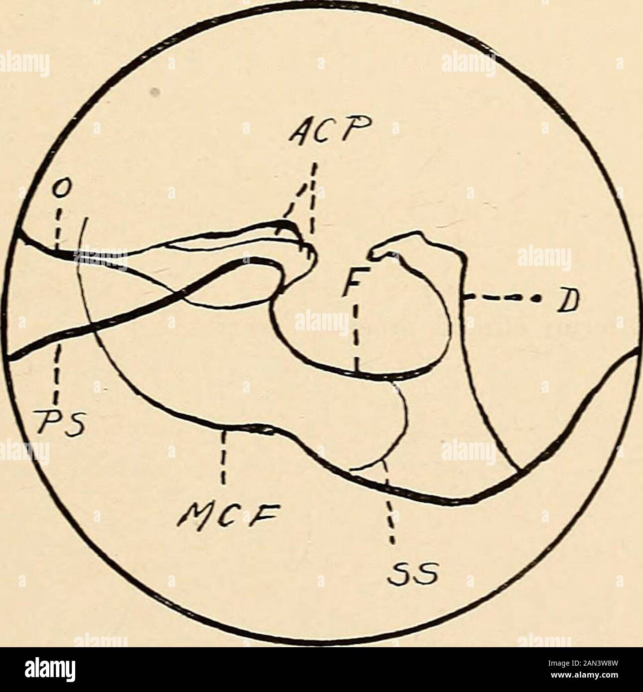 Diagnóstico de Roentgen de enfermedades de la cabeza . Fig. 49.—un cuadro  dextrosínistral de un caso* de acromegalia con una leve erosión de la silla  turca como aparece en el perfil. Se
