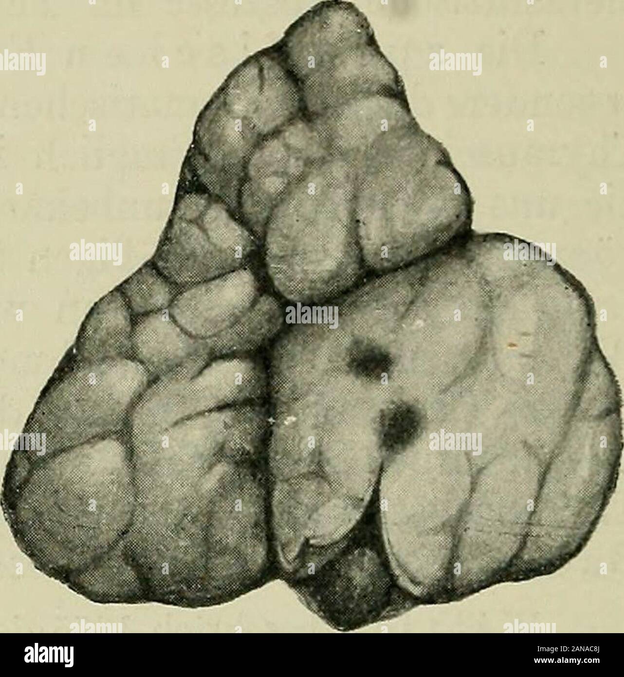 Chirurgie Der Thymusdruse In Von Schi O Ss M A N Furdas Gehalten Pyobacterium Fischeri Un Kranken Westmacow Sah Einen Erstickung Durch Thymusabszess Zu Grunde Gehen En Einem Falle Von Vargas Entwickelte