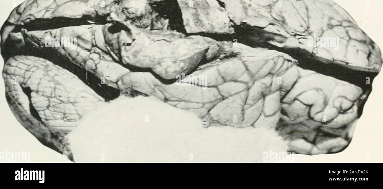 AMAarchives de Neurología y Psiquiatría . ^U:J^- - ^^ /. Fig. 1.-Tumor mostrando su relación con los dos tercios posteriores de la primera y segunda gyri temporal. Foto de stock