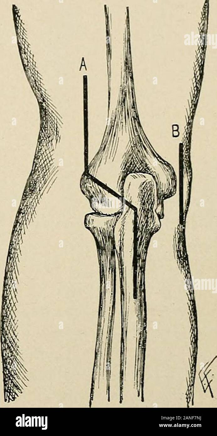 La práctica de la cirugía. Fig. 655.-La ablación sobre el codo: A,escisión  del codo-Articulación con incisión (Langenbecks posteriormedian  opera-ción); B, B, la escisión del codo-joint byradial y cubital incisiones  laterales; C,la escisión