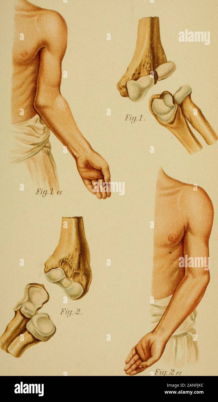 cúbito valgo y cúbito varo