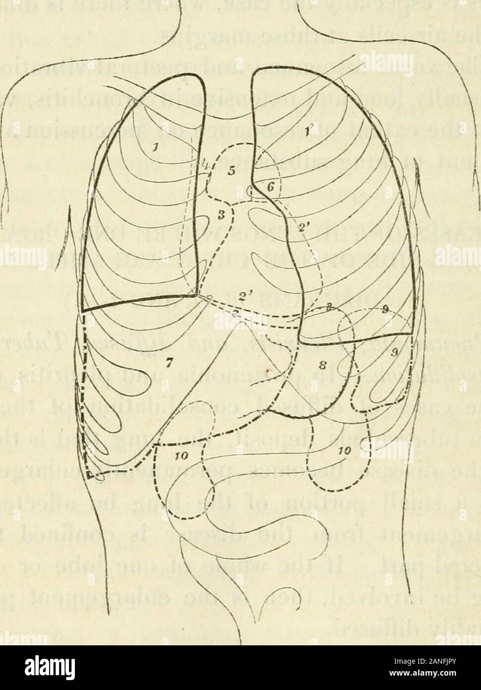 Transacciones . t de resonancia a la percusión y theamount de sustancia de pulmón. Enfermedades de los pulmones, donde un órgano Andoni lado del pecho se amplifican. (Diagramas de 16, 17 y L. 5.) La neumonía, pleuritis y difundido TuberculousConsolidation.-En la neumonía y la pleuritis, y en unos casos de consolidación de la difusa Iuhjj:desde el depósito, el tuberculoso pulmonar que es la seatof la enfermedad llega a ser ampliada permanentemente. Ifbut una pequeña porción del pulmón se verán afectadas, theenlargement desde la enfermedad está confinada a theaffected parte. Si la totalidad de un lóbulo o de onelung estar involucrados, es entonces el Foto de stock