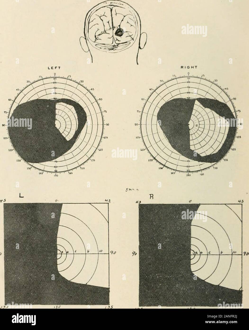 AMAarchives de Neurología y Psiquiatría . /*", Fig. 7 (caso 7, M. D