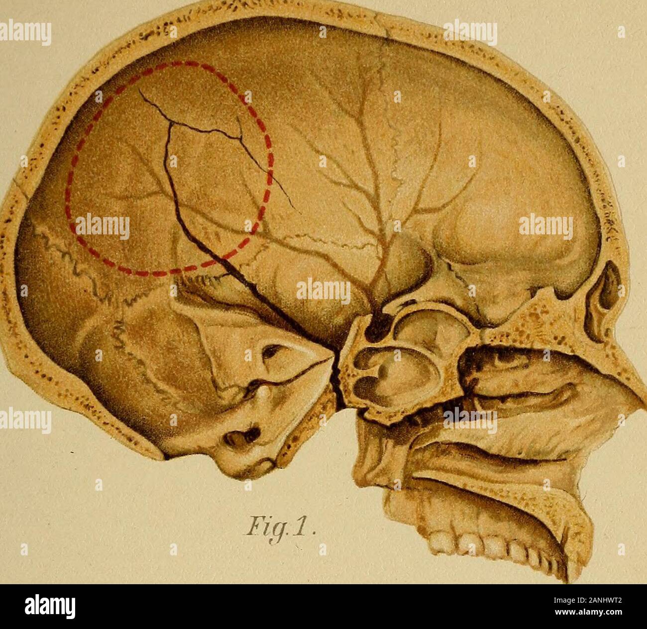 Atlas y el epítome de las fracturas traumáticas y dislocaciones . eft  huesos frontal y parietal.(Autores observación.) Fig. 2.-sección horizontal  a través del cráneo y su contenido. Acopious hemorragia de la arteria