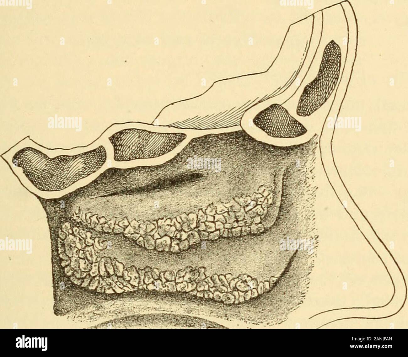 hemorragia secundaria