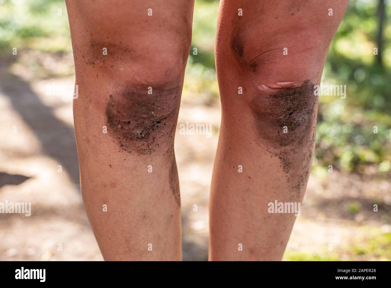 Las rodillas sucias en una mujer adulta, cerca, en el campamento, sobre un fondo borroso. Foto de stock