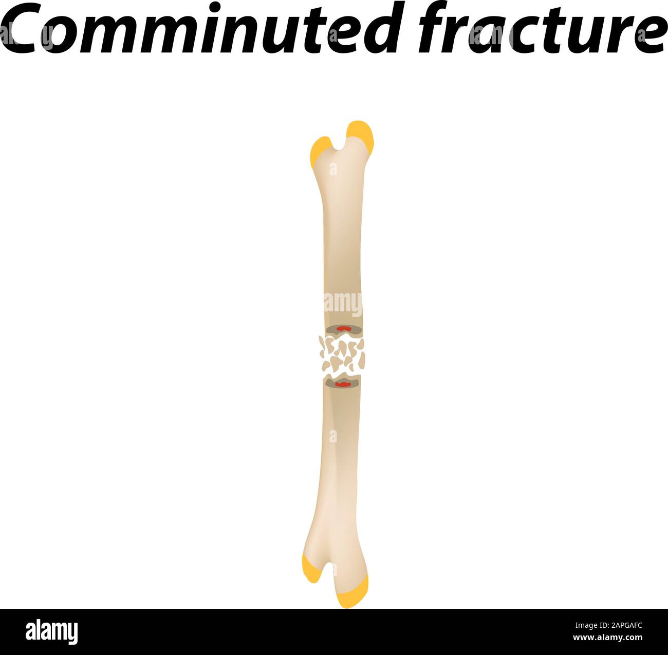comminuted fracture drawing