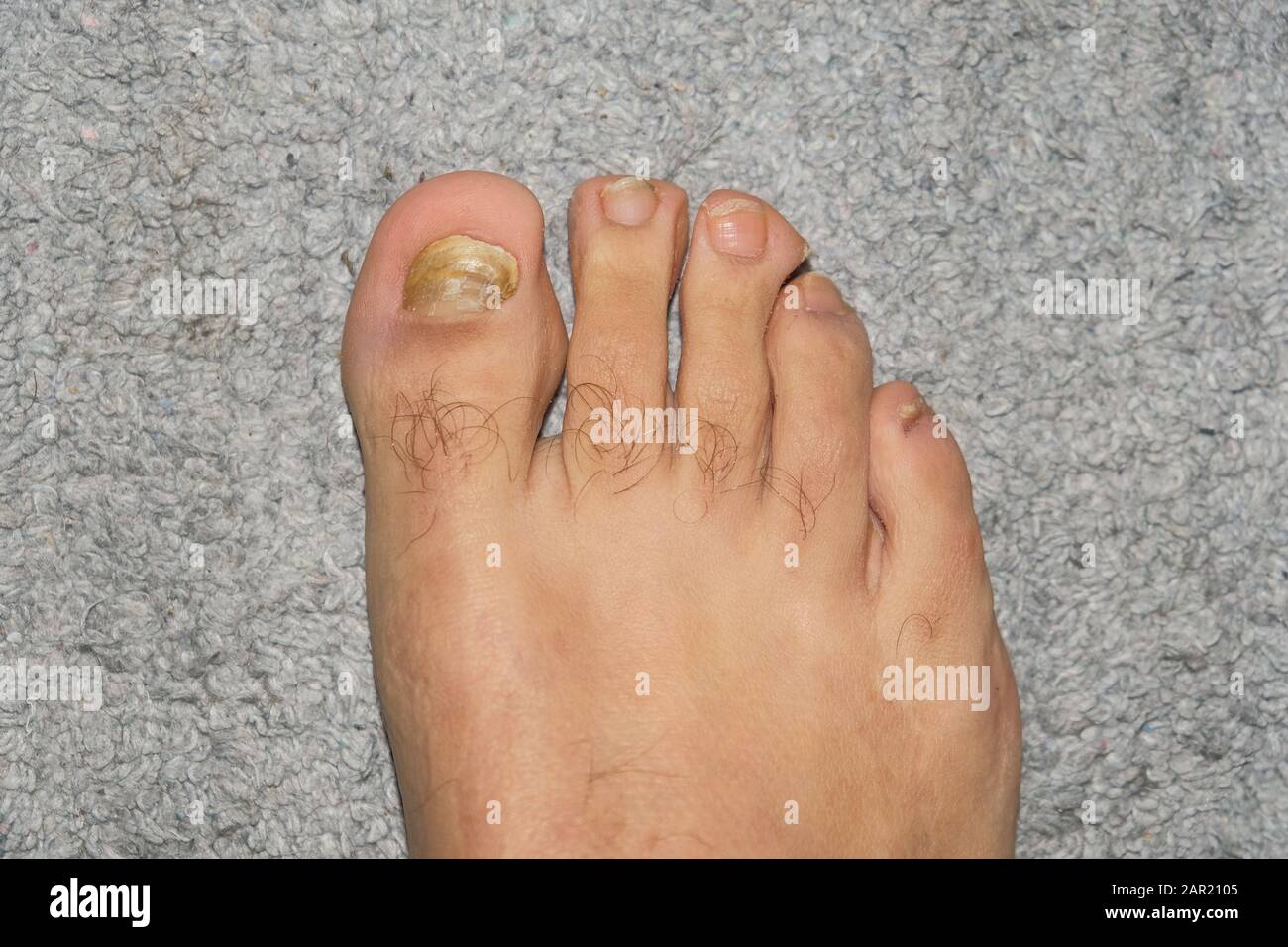 Hombre joven descalzo dedos con micosis onycho uñas enfermos, dermatológicos problemas Foto de stock