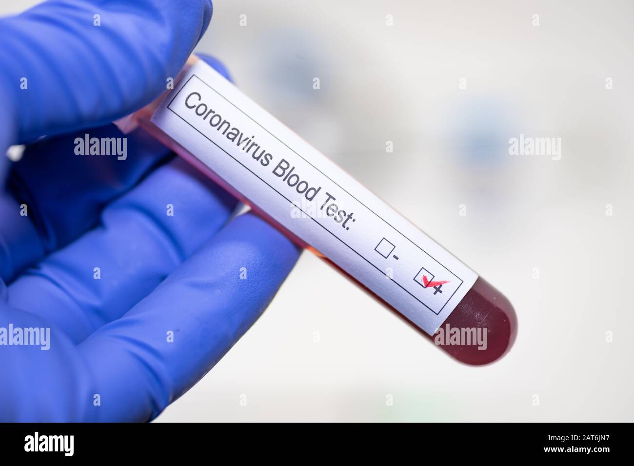 Sangre positiva de coronavirus en un tubo de extracción de sangre Foto de stock