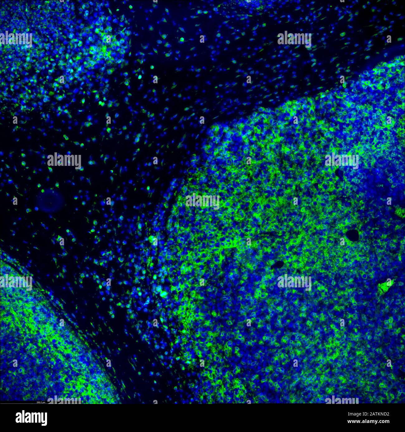 Inmunofluorescencia tumoral imagen de IHC del tratamiento de inmunoterapia. Células tumorales en azul atacadas por linfocitos T del sistema inmunitario en verde Foto de stock
