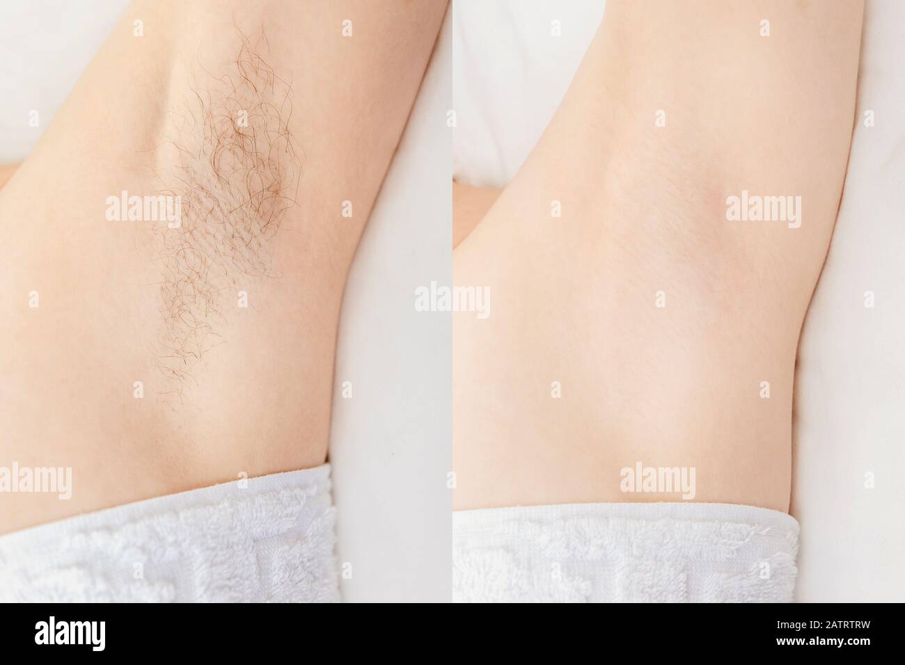 Mujeres axilas depilación. Concepto antes y después de afeitar el láser de  depilación con azúcar Fotografía de stock - Alamy