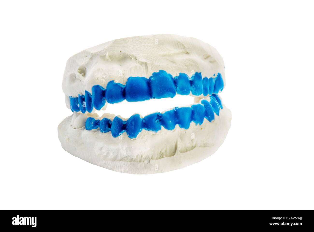 Moldes dentales de yeso con los dientes pintados de azul brillante. Este es el conjunto superior e inferior. Aislado sobre fondo blanco. Foto de stock