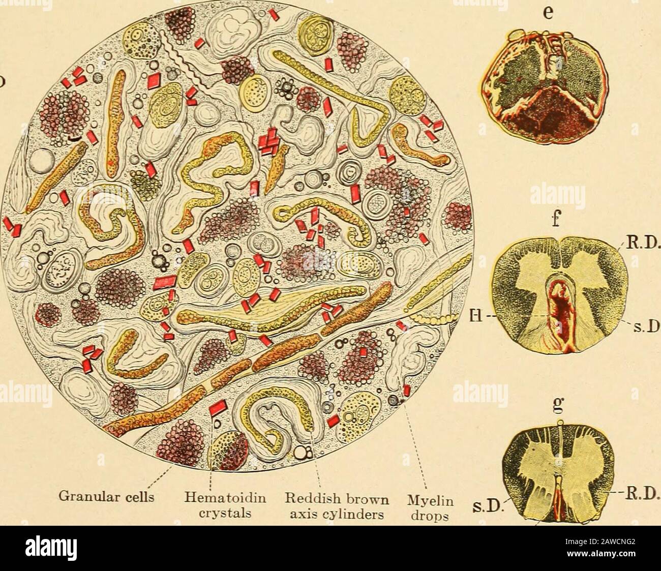 Tabes dorsalis fotografías e imágenes de alta resolución Alamy