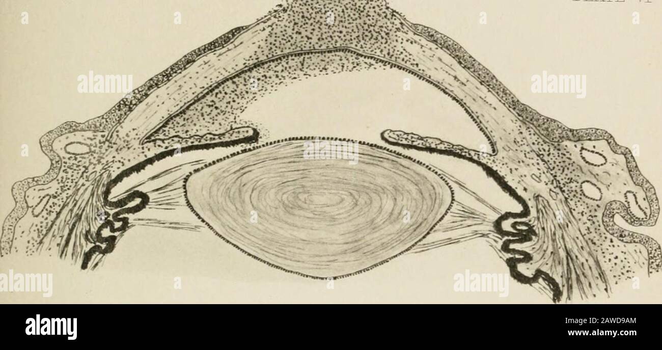 Lesiones oculares y su tratamiento . la figura representa el ojo de una  mujer de cuarenta y ocho años de edad, que ha sufrido durante dos años de  ulceración corneal progresiva. Las