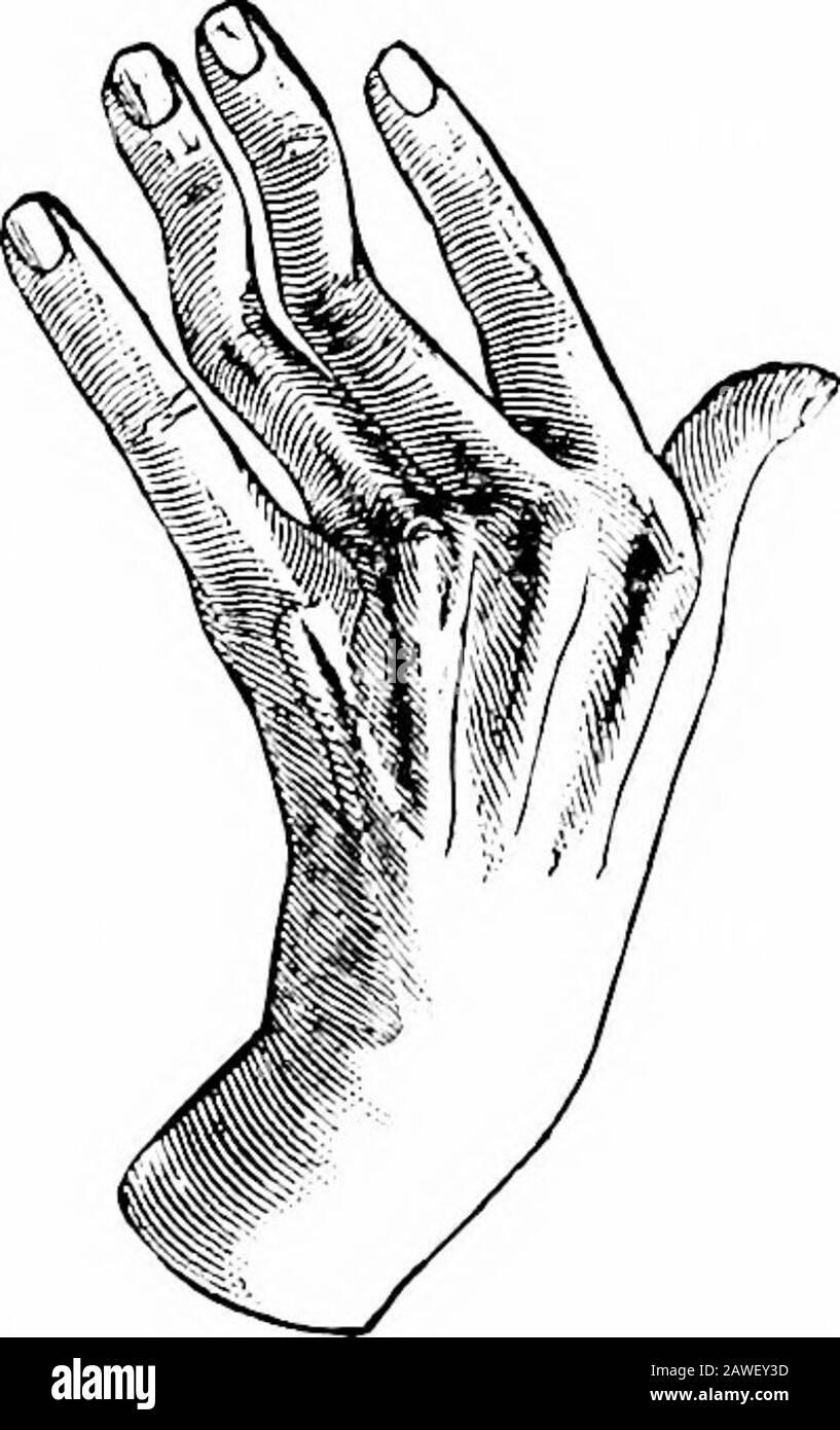Anatomía aplicada y kinesiología, el mecanismo del movimiento muscular .  Fig. 86.—mano en forma de garras resultante de la parálisis de los  Iumbrales e interóseo utilizados por una lesión al nervio cubital. (