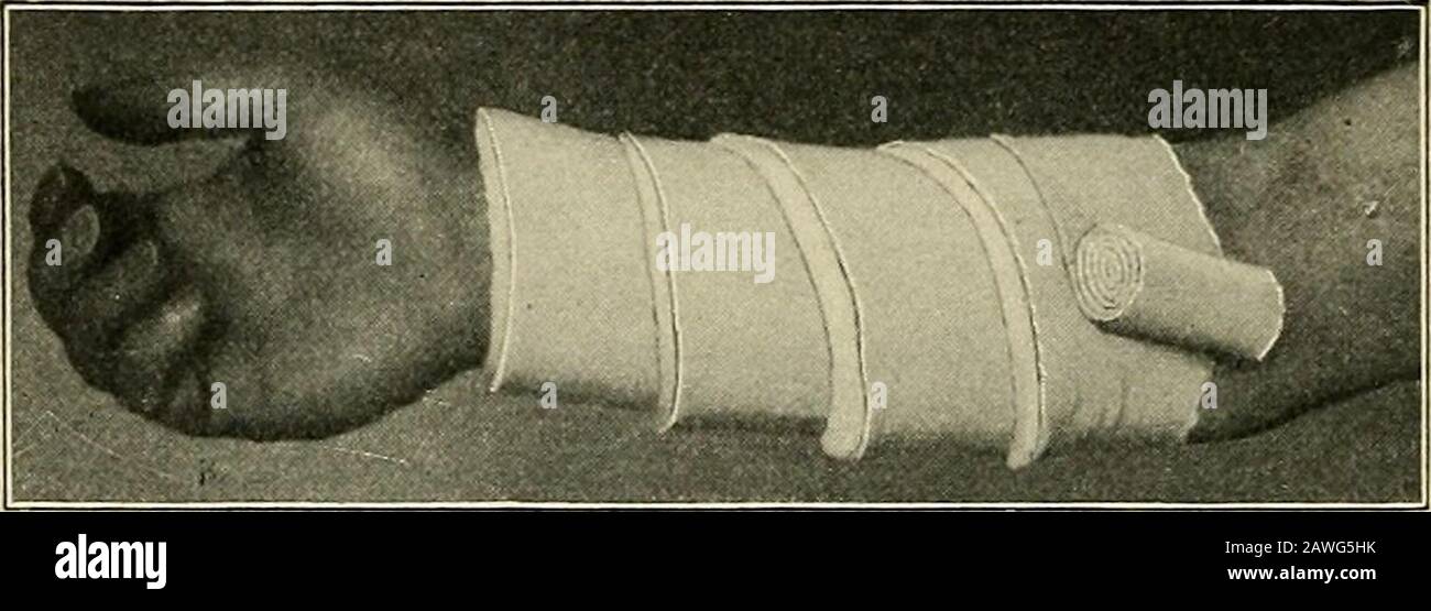 El quirófano y el paciente; un manual de tratamiento preoperatorio y  postoperatorio . Fig. 35.—se aplica un vendaje de Essmarchs. Mostrar método  de aplicaciónsin superposición. Las tres últimas vueltas sirven como  torniquete. (