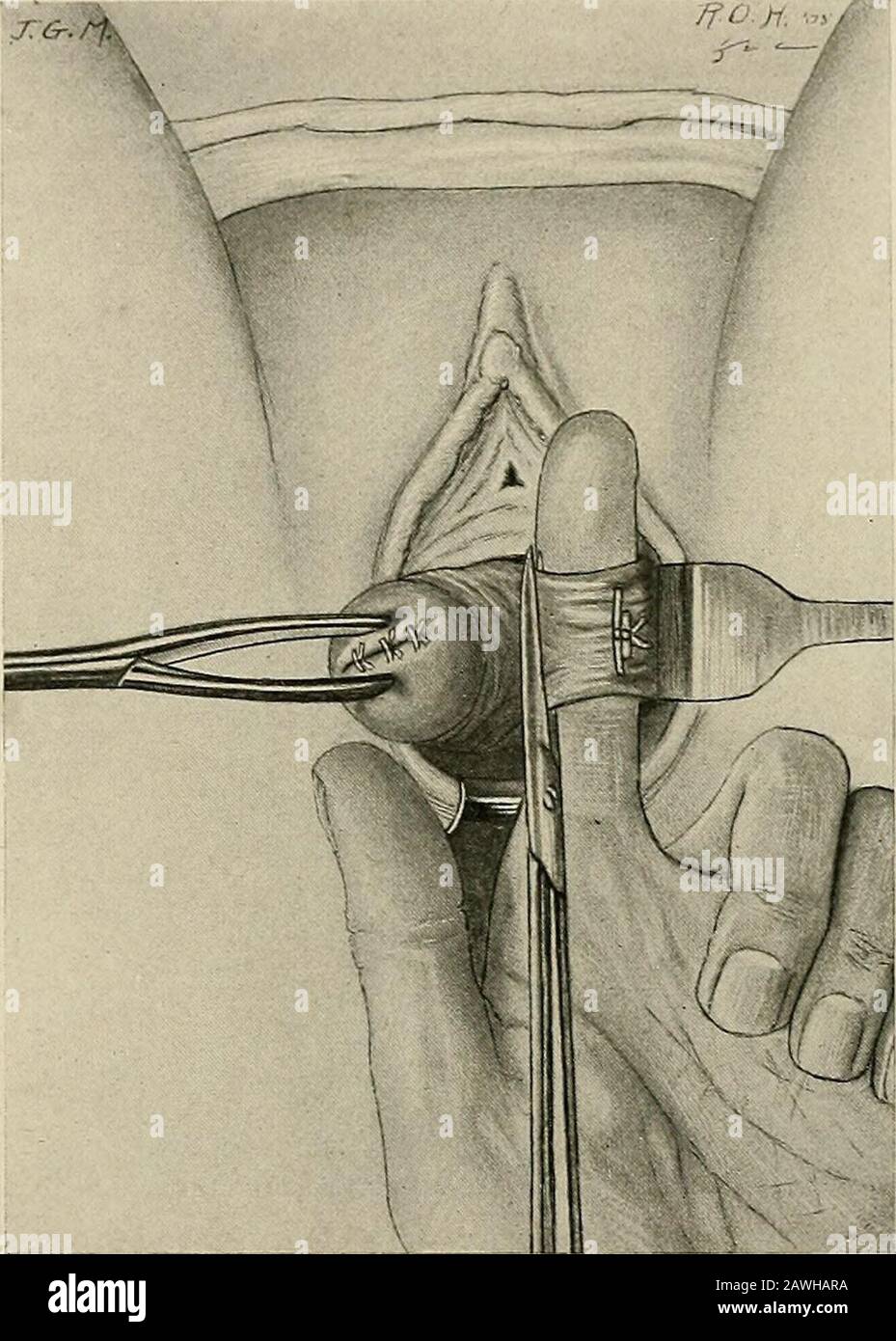 La práctica de la cirugía . Fig. 195.—histerectomía vaginal—paso r&gt;  iadapt(&gt;d de Dudley). Los tumores DEL ÚTERO 313 enfermedad, sutura  firmemente el os, para prevenir el ensuciamiento de la herida por descargas,