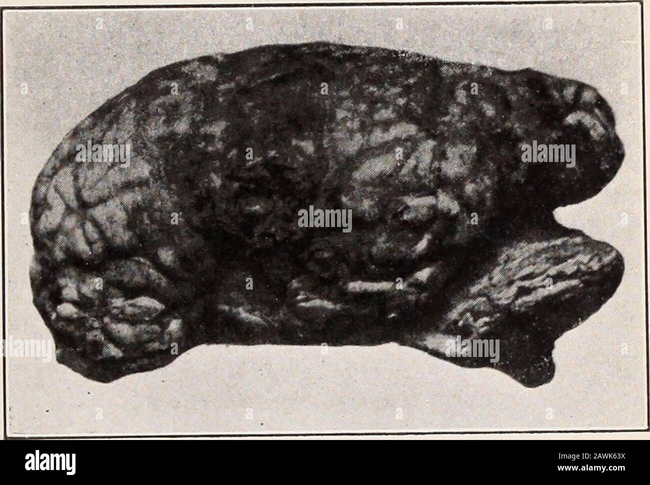 Alienist y neurólogo. . perdido en la porción petrosa del hueso temporal y  se extiende transversalmente a través de la base del cráneo hasta un punto  corresonante en el hueso temporal izquierdo.