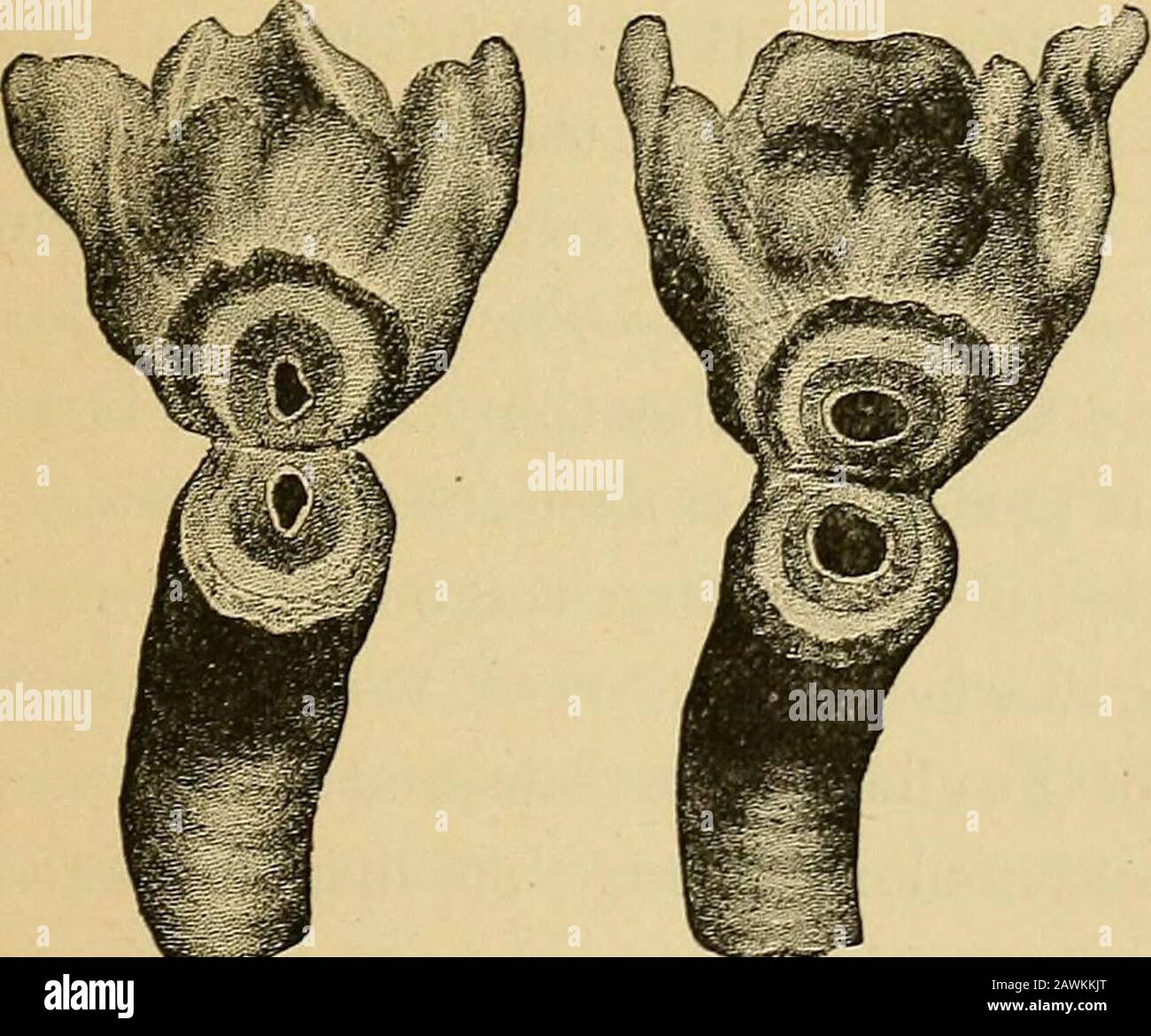 Difteria, su naturaleza y tratamiento . flexible. Fig. 7 representa la luz normal de la subglotticdivisión de la laringe de un niño de la misma edad, y Fig.8 una sección de la tráquea de la misma muestra la mayor diferencia en el calibre del pasaje aéreo en estos puntos. He utilizado el tubo 5-7 a los dos años de edad para obtener el beneficio del aumento de la longitud o la cabeza más grande, y FORMAS DE ESTENOSIS DE LA LARINGE. 269 esto se puede adoptar cuando hay una obstrucción de la producción de pseudo-membrana en la extremidad inferior o tejido hinchado que sobrehace la cabeza del tubo más pequeño. Mayor Foto de stock