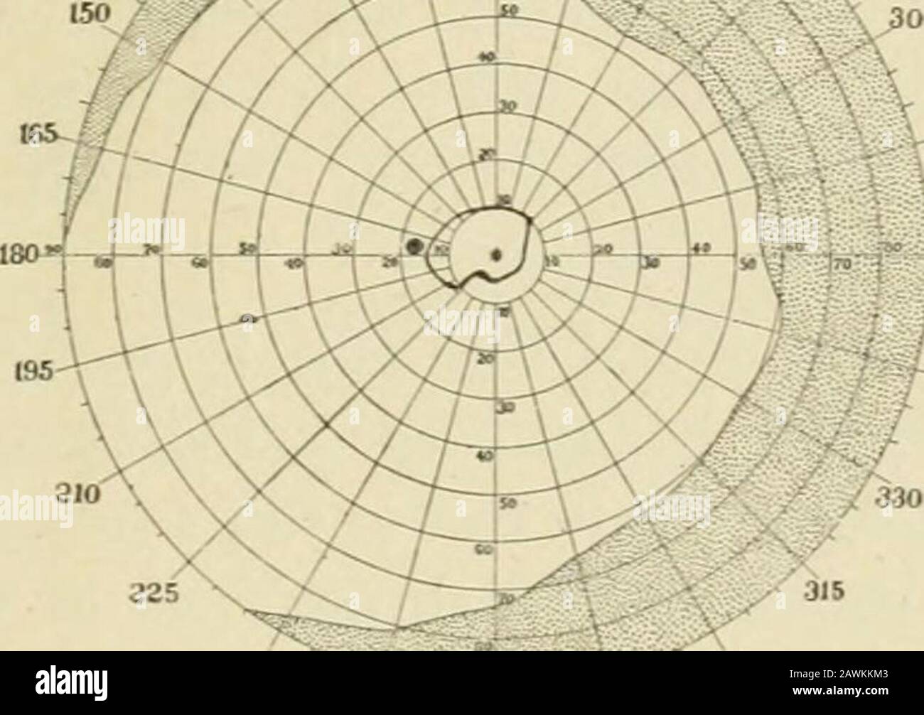 Transacciones . Wadsworth : Embolismo De La Arteria Central. 587. el lado temporal, una neblina blanca se extiende por una larga distancia, gradualmente desvaneciéndose; cerca y en el disco la neblina parcialmente hidesthe vasos ; por encima de la mácula unos pocos vasos finos se destacan en ella. Desde el borde del disco hacia fuera un área del eo , ?, la retina del eo que incluye el ma- a , cula es absolutamente libre de haze.El borde del haze-ató el lado inferior de esta arealies un poco debajo de la arteria cilio-retinal descrita, andis no muy definido ;sobre el área el borde de la neblina es bastante afilado, desde el borde de la di Foto de stock