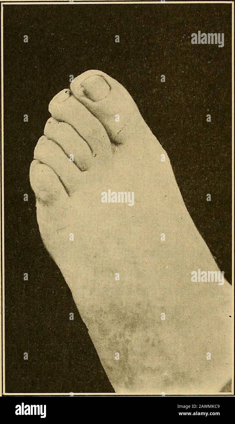 aa bolsagage allowance
