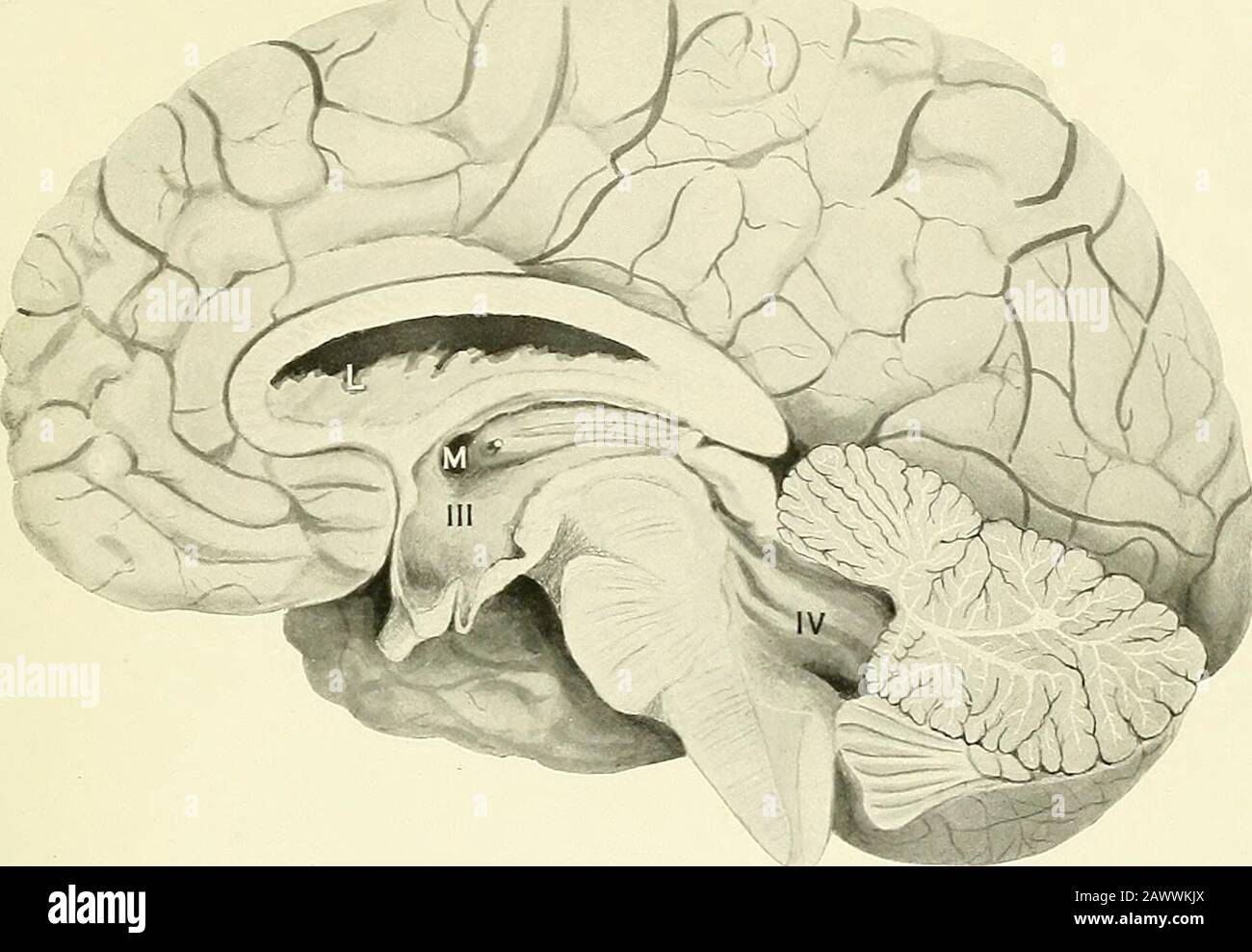 Fiebre cerebro-espinal . erción del índice. Las Téconvoluciones del cerebro se aplanan, pero no en grado extremo. El cable de la misma caja es pelado en la placa X, fig. .3. El bloqueo en el espacio sub-aracnoideo en la región dorsal superior impidió la rehef de la pressureación ventricular por punción lumbar. No hubo un bloqueo evidente en la región del plexo coroideo del ventrículo foiu-th, aunque éste fue adherente en un grado considerable al theerebellum. Fig. 2. El cerebro de un caso agudo que murió el décimo día de la hemorragia retroperitoneal iUness. Incluso en esta etapa temprana bien Foto de stock