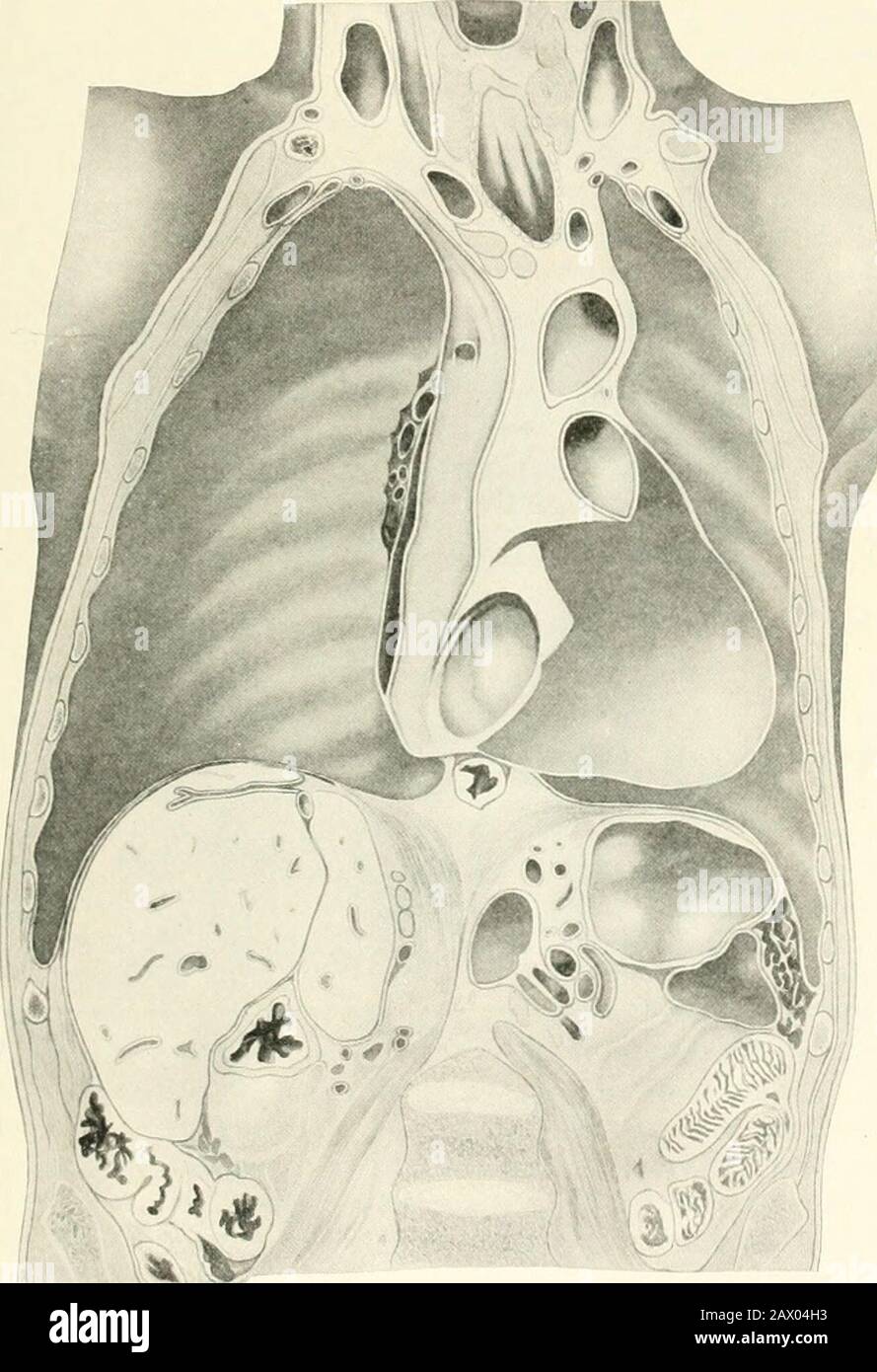 Tuberculosis clínica . I.-ig  55 —Posición de los órganos abdominales e intratorácicos en la edad de 36 años. Cotiiiiare con Figs. 54 y 56. (Mehnert.). Fig. 56.—Posición de la diaplnagm y de los órganos abdominales y aeic intialhoi en la edad de 11 años. Comparar con Figs. 54 y 55. (Mehnert.) Foto de stock