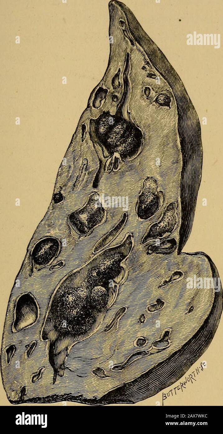 Gall-stones y enfermedades de los conductos biliares . los conductos  hepáticos se becaron con pus. Otra condición rara es la ruptura del  hepaticduct como consecuencia de la ulceración causada por la piedra.