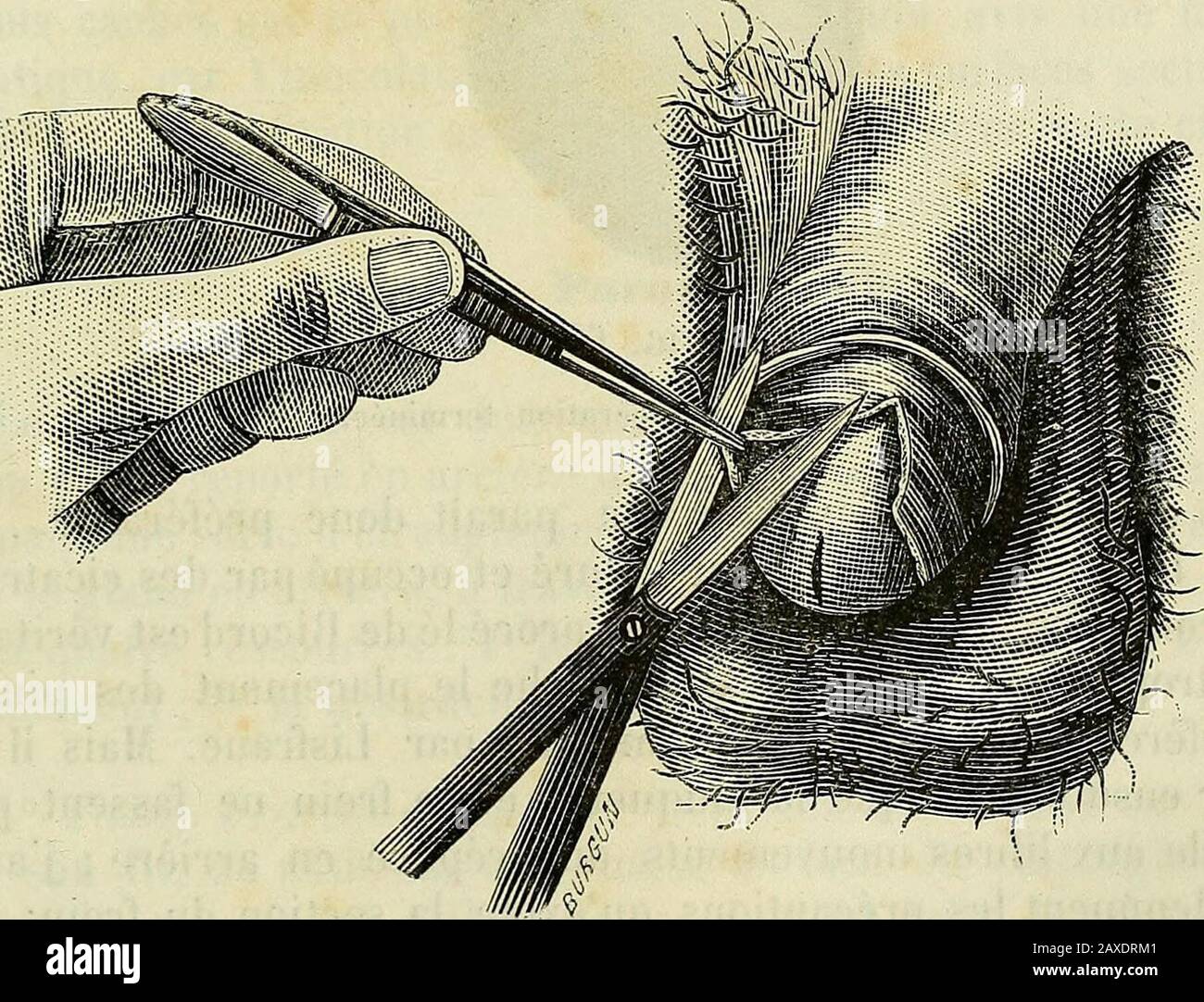 Manuel de médecine opératoire . Fig. 604, Fimosis. — Etat des parties molles après lescisión