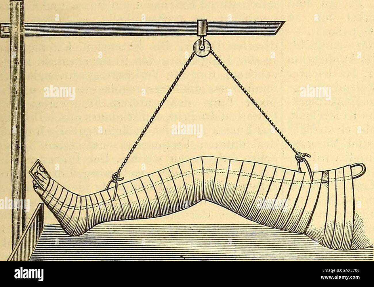 Therapeutisches Lexikon : für praktische Ärzte . 461 FRACTUR. 462 festes Kissen oder eine Beckenstütze gelagert.Zwischen die Schenkel um die Basis der ge-brochenen Extremität kommt die Contra-extensionsschlinge, welche aus einem durchein Stüdicken Gummischlauch gezogenenund an dem Enden Gurätten Fätten. 22.. Besteht, und wird an einem am oberen Bett-rand eingeschraubten Haken oder sonst einempassenden fixen Punkt der Art befestidt, dassder Patient darauf reitet. Nun wird der Fussmit einer schmalen Flanellbinde gut einge- Fig. 23. Foto de stock