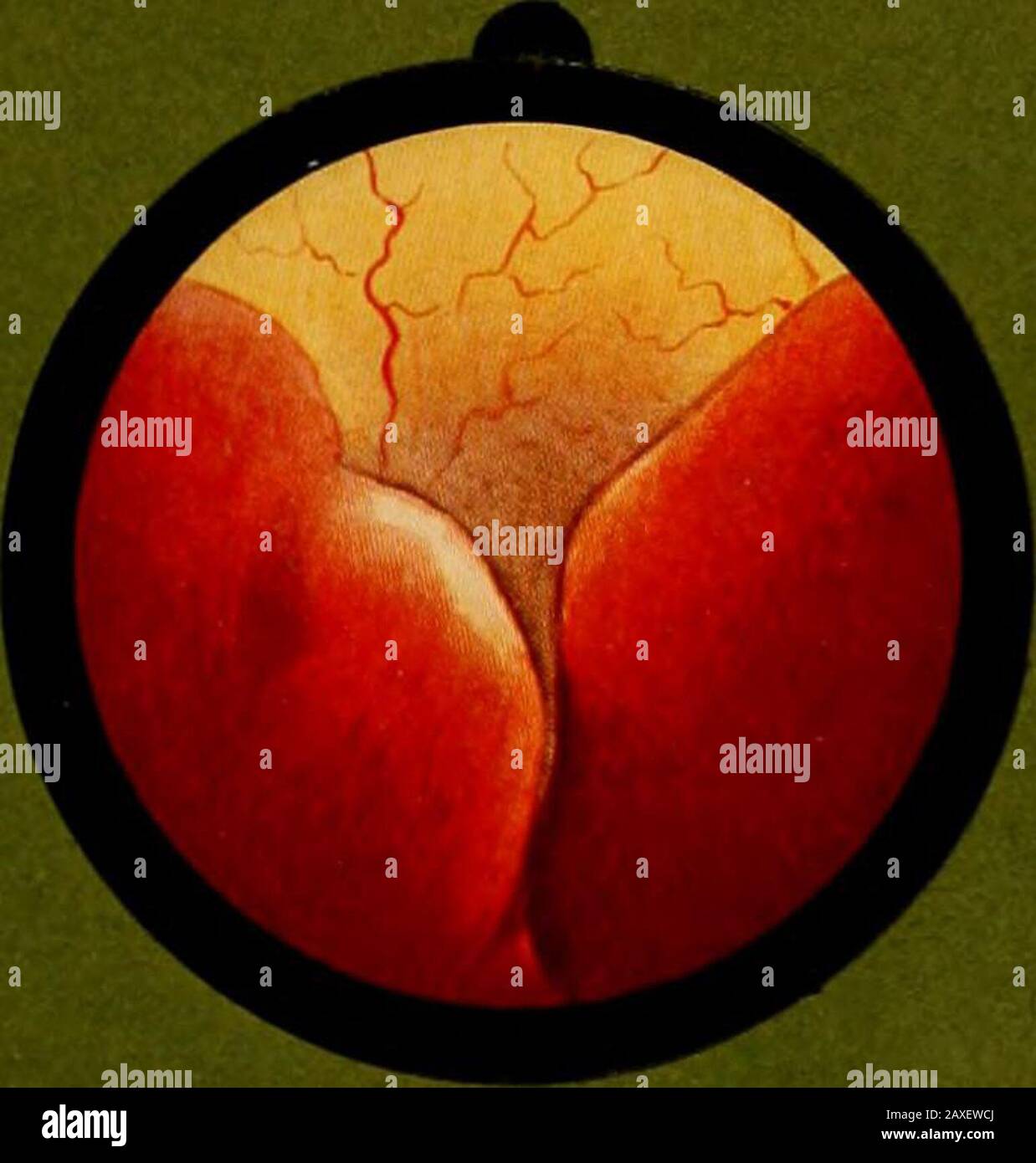 Traitâe pratique de cystoscopie et de cathâetâerisme urâetâeral . Fig. 3 Foto de stock