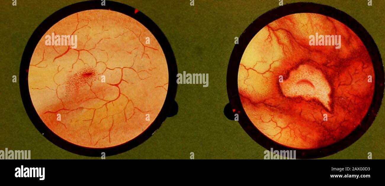 Traitâe pratique de cystoscopie et de cathâetâerisme urâetâeral . gaping a través de ulcération de los bordes del ils. Stampa X. FLG. 1. — Mealo ureterale cireomlalo da nna punleggialura emorragien. Fig. 2. — Mealo formato che si âpre en mezzo duna ulcerazione tubercolosa. Fig. 5. — Mealo spalancato con condensazione délie suc labbra. Fig. 4. — Meato spalancato con orli rigidi e sclerosi. Fig. 5. — Mealo scleroso che si âpre en mezzo diins ïonl bianca cicatriciale dorigine operatoria.Fig. 6. — Meato tubercoloso spalancato per ulcerazione dei suoi orli. Lámina X. Fig. 1. — Meato ureteral rodeado de un > Foto de stock