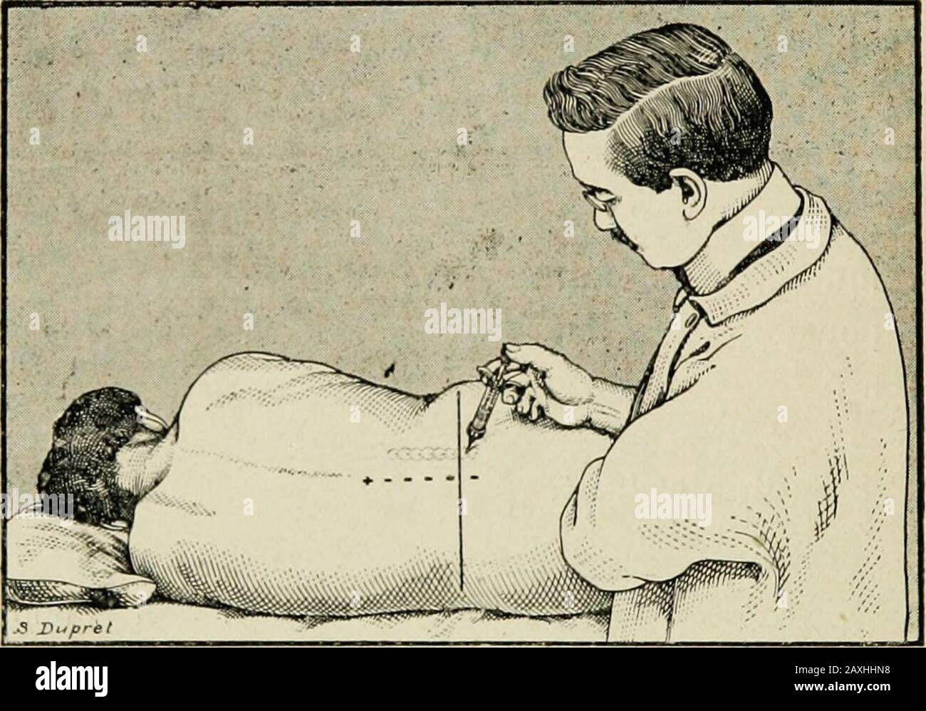Contribucion à l'ʹetude de l'anesthʹesie paravertébrale en chirurgie gastrique et intestinale . ousser lentement linjección commeil est dit plus halit. Pour la paravcrtêhraie luinbuirc, noire techniqueest à peu près celle de Pauchet, Sourdat et Laboré.Piquer laiguille à 3 cm. De la ligne médiane, en re-gard de langle supérieur de lapophyse épineux,prendre conacto avec lapophyse et supérieur en suférille, péléperse et d Lenfoncerde 2 à 3 cm. Et là inyectable 5 à 6 c. de la solution en (i) Gaston Labat. — Palhogénie de la Foto de stock