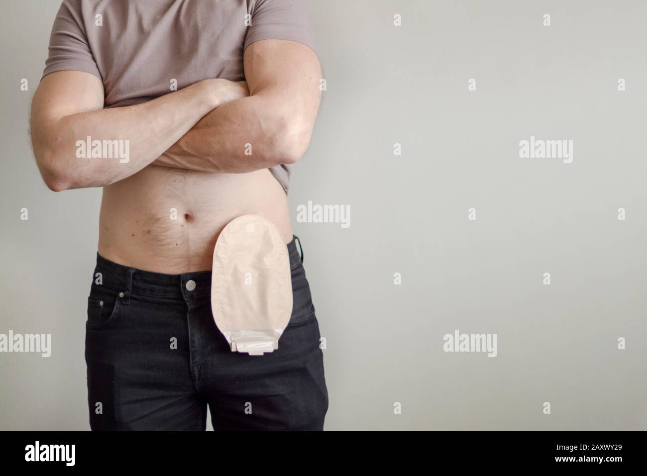 Vista frontal de la bolsa de colostomía acoplada al paciente del hombre,  tema médico. Enfoque selectivo en el primer plano de la bolsa de ostomía  del color de la piel. Tratamiento de