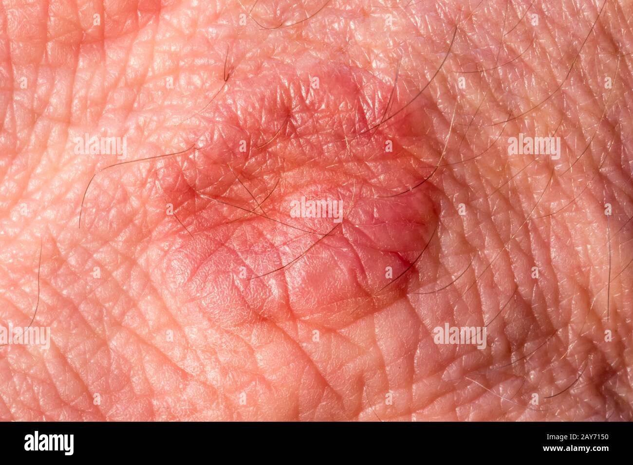 Piel Con Sarpullido Eczema Fotografia De Stock Alamy