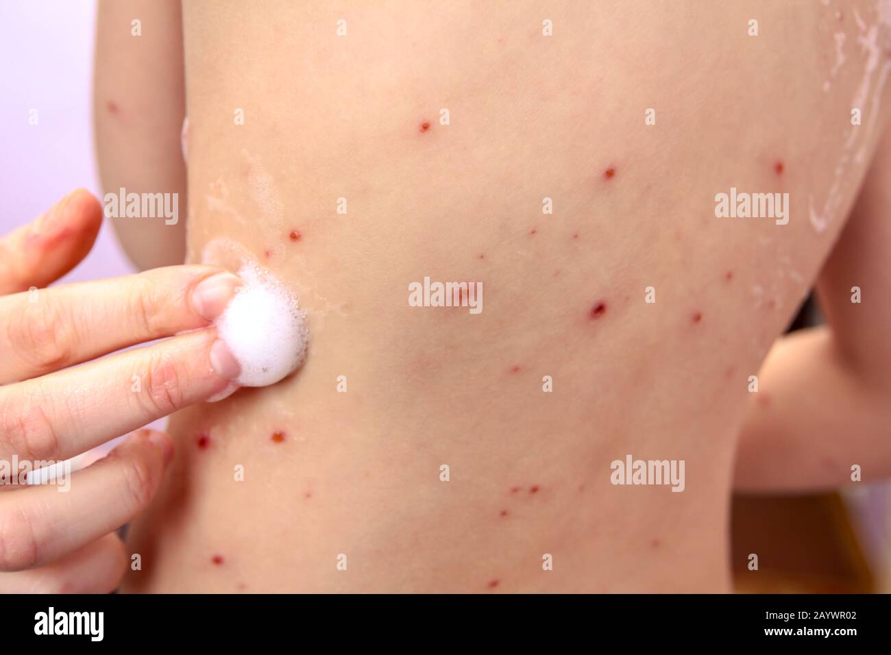La piel del niño infectado con varicela es tener tratamiento usando un antiséptico espuma. Foto de stock