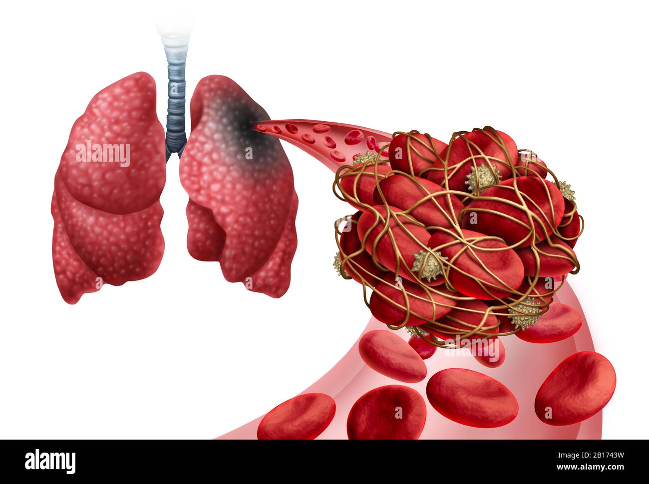 Embolismo pulmonar con coágulo sanguíneo como enfermedad con obstrucción de una arteria en los pulmones con elementos ilustrativos en 3D. Foto de stock