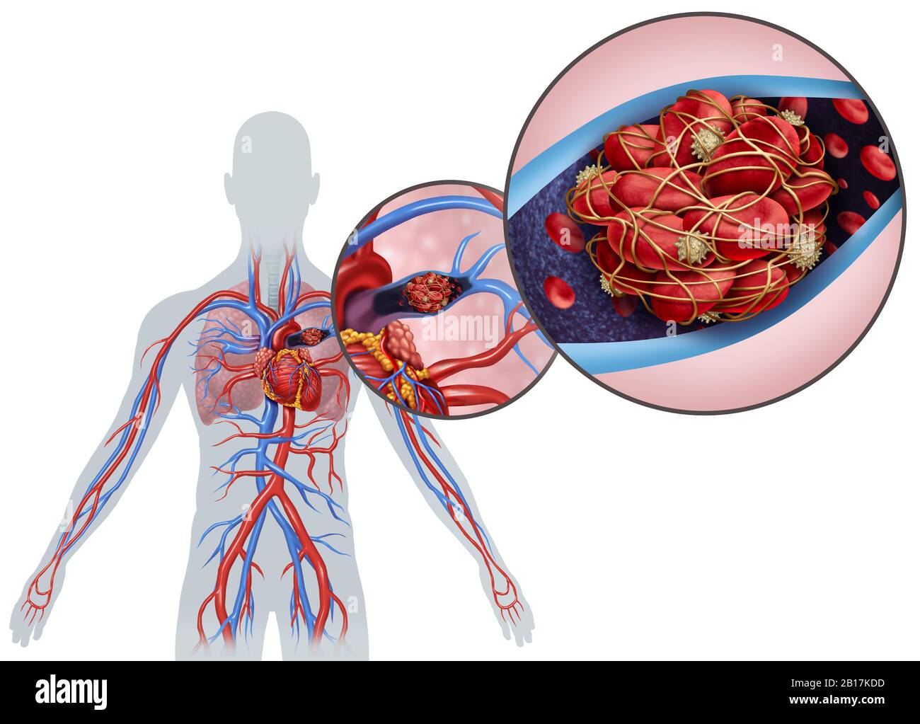 Embolismo pulmonar con coágulo sanguíneo como enfermedad con obstrucción de una arteria en los pulmones con elementos ilustrativos en 3D. Foto de stock